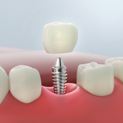 Implant Dentistry