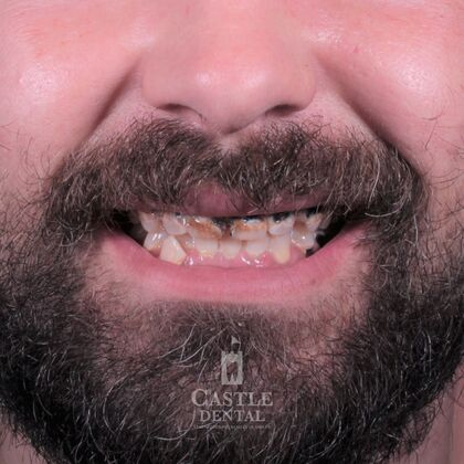Castle Dental Group patient before dental crowns