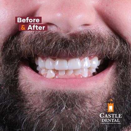 Castle Dental Group patient after dental crowns