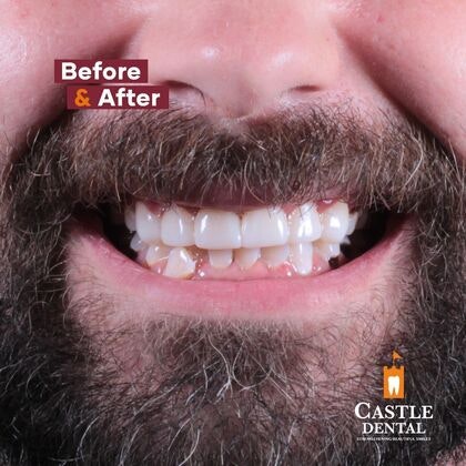 Castle Dental Group patient after dental crowns