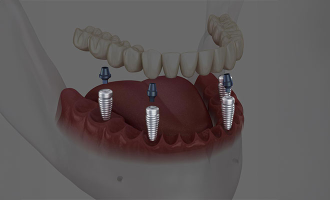 Dental Implants