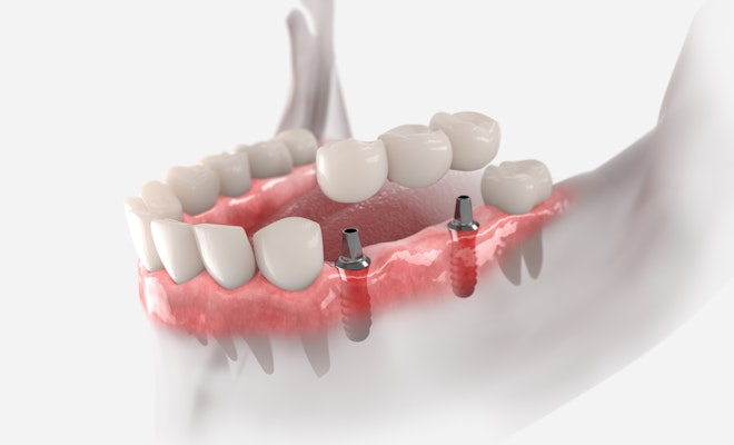 Implant-supported bridge illustration