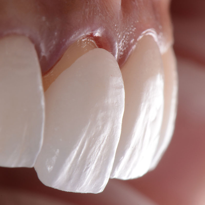 veneer being placed on a tooth