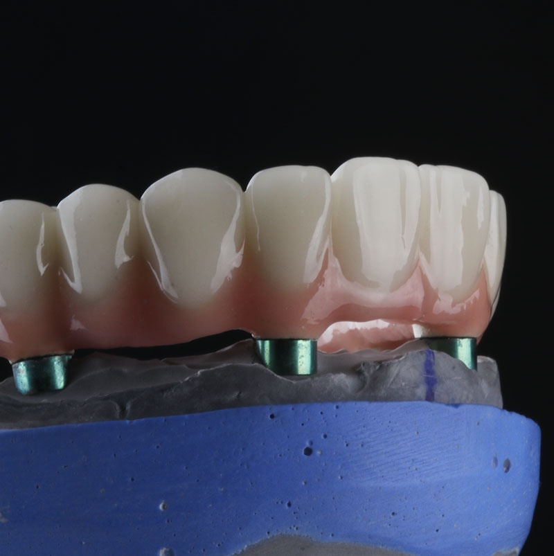 All-on-4 denture