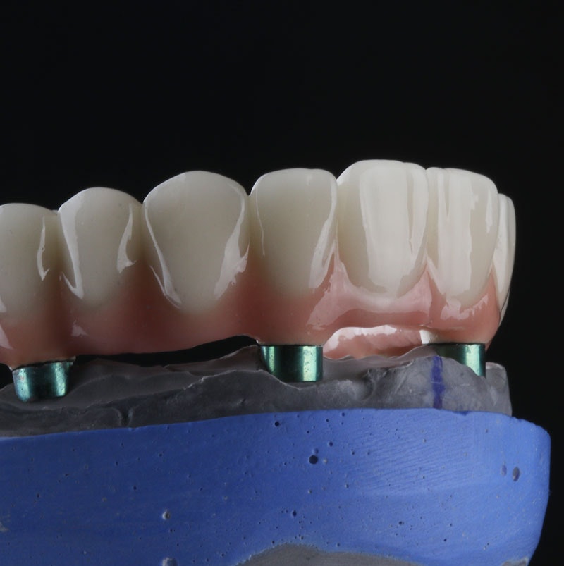 All-on-4 denture