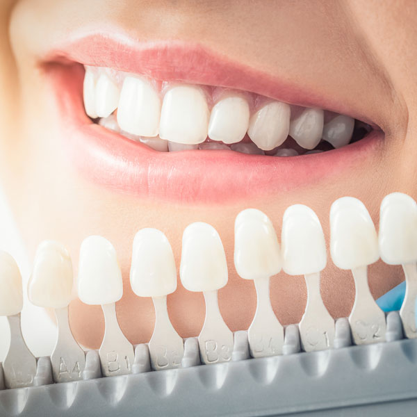 woman getting shade matched for veneers