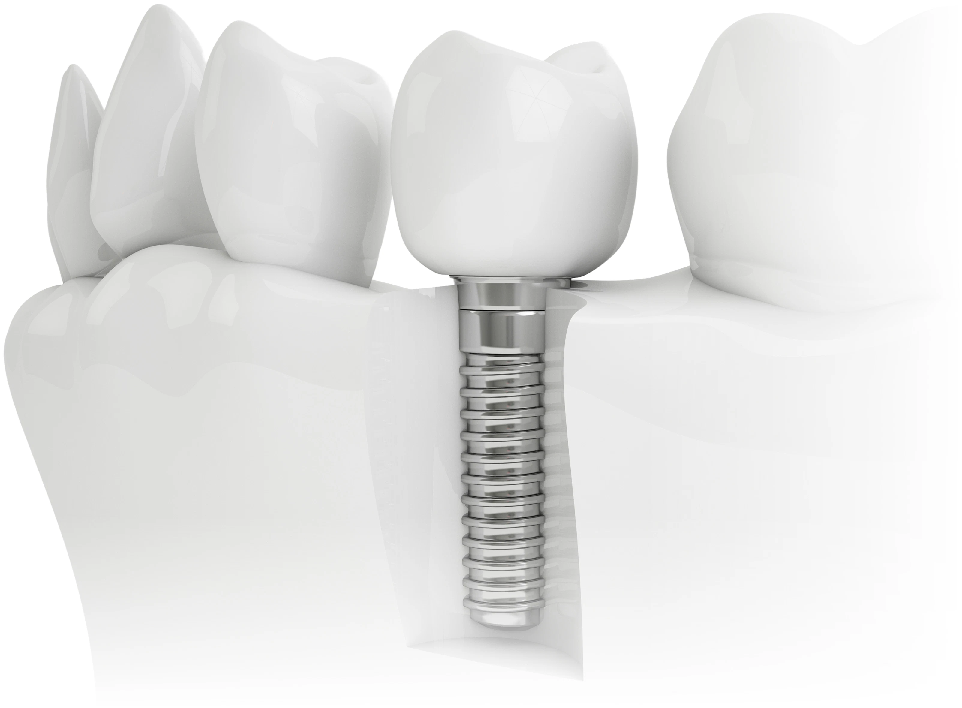 implant-supported crown