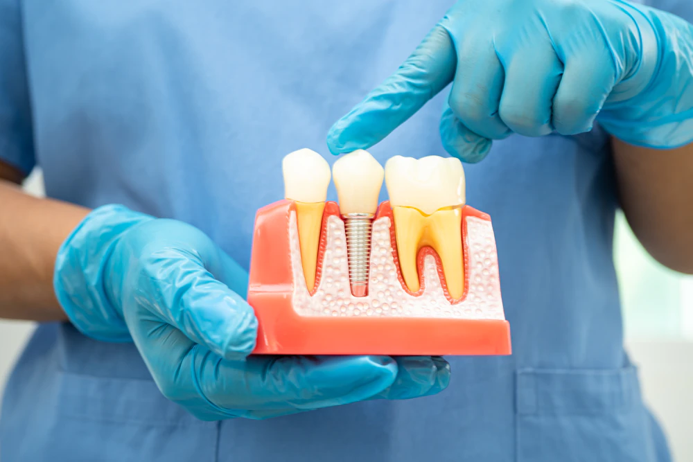 plastic model of implant-supported crown