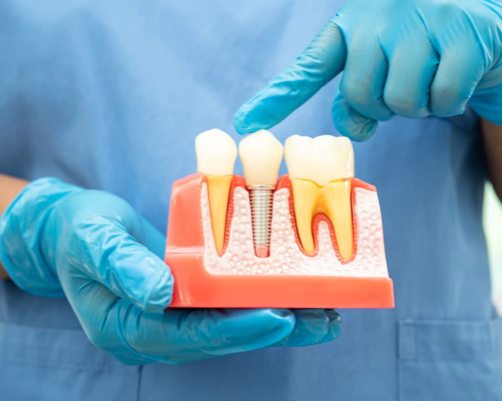 plastic model of implant-supported crown