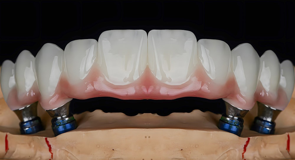 digitally rendered model of all-on-4 implants