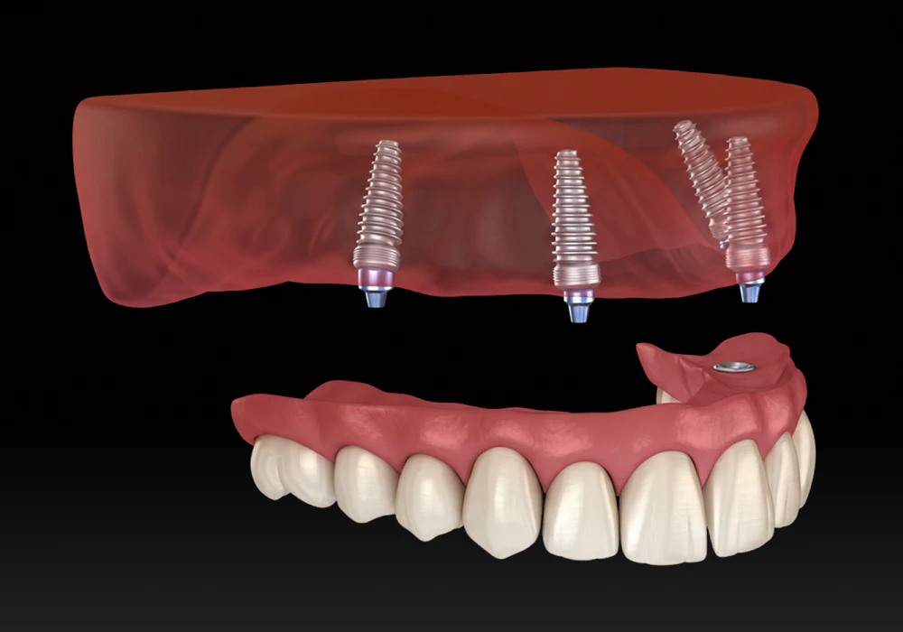 digitally rendered model of all-on-4 implants
