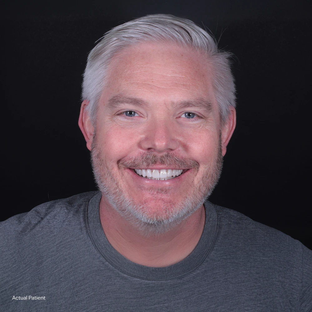 After results from a real Castle Dental patient - middle aged man with white hair and lovely smile
