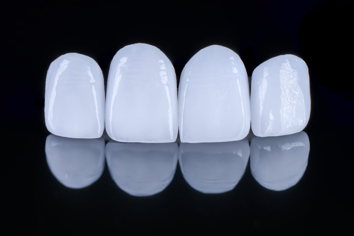examples of pearly white veneers