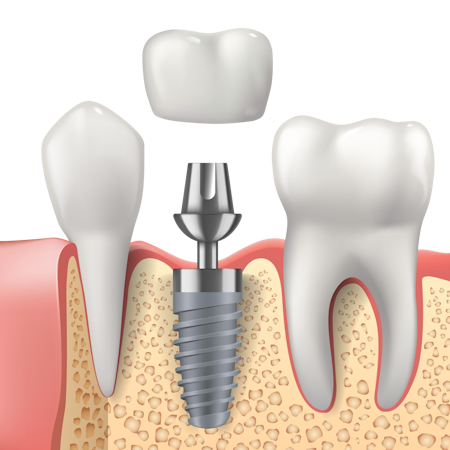 cross-section of a dental implant in the jawbone