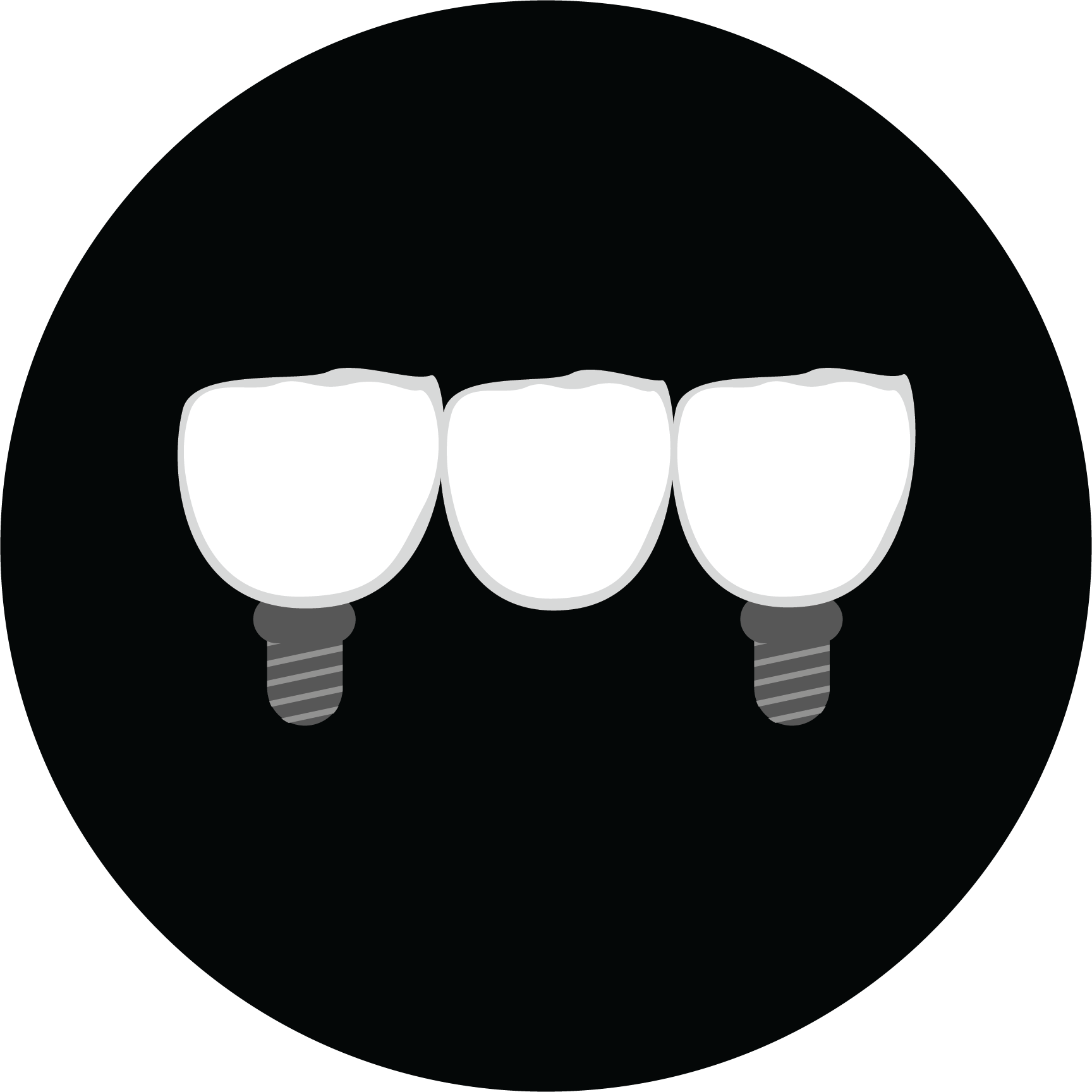 Illustration of an implant-supported bridge