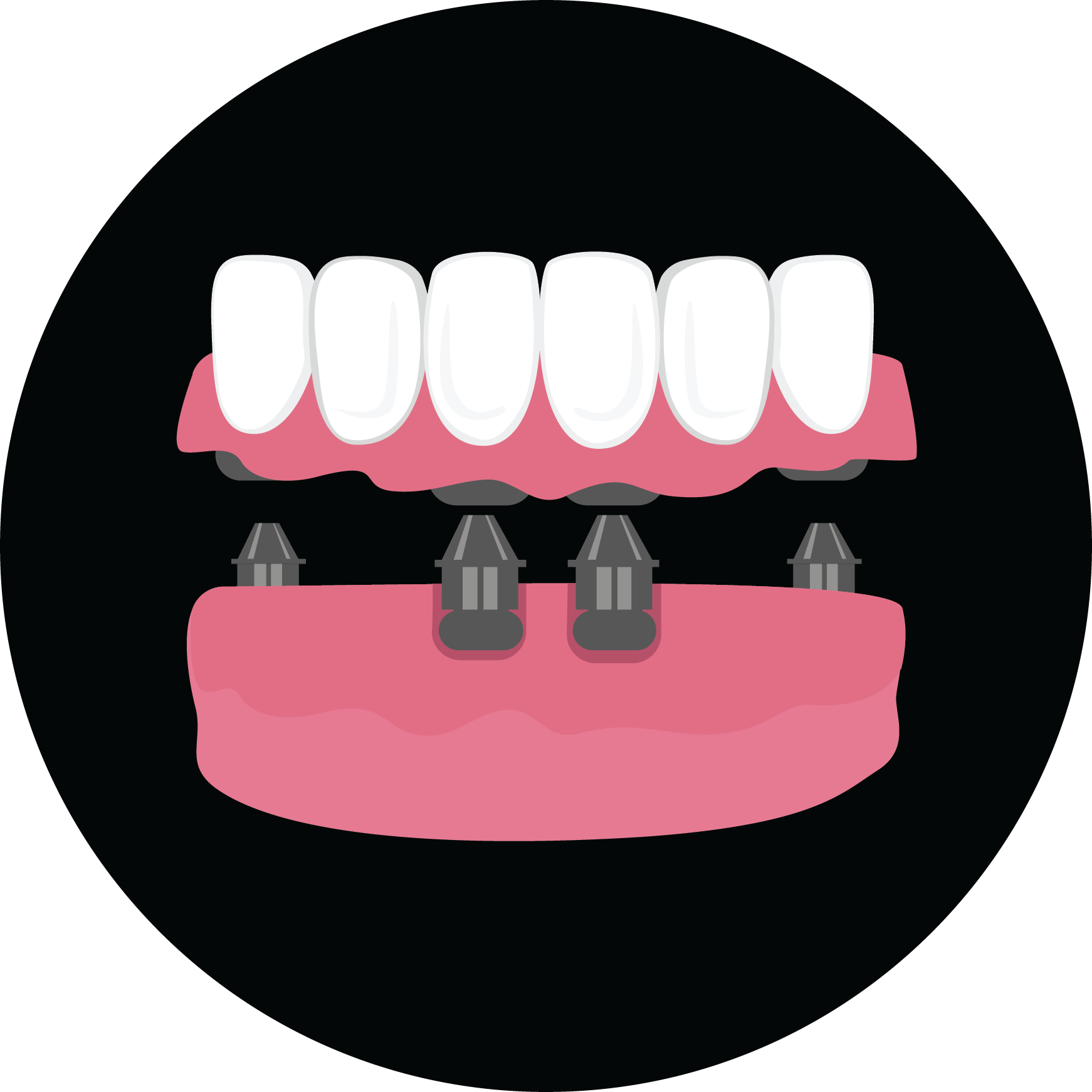 Illustration of an implant-supported denture