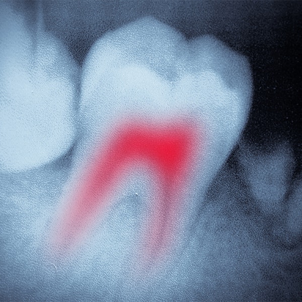 tooth x-ray