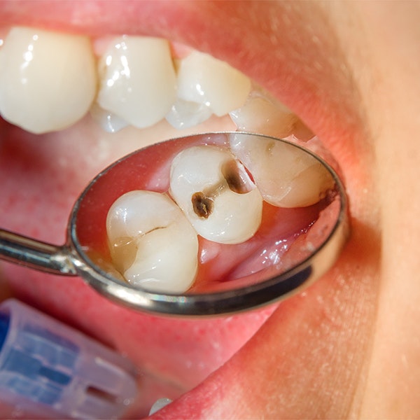 tooth with a cavity