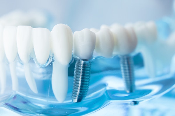 implant supported crown