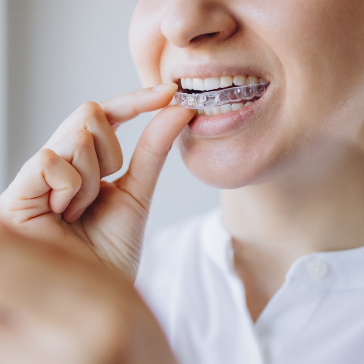 Woman inserting Suresmile aligner