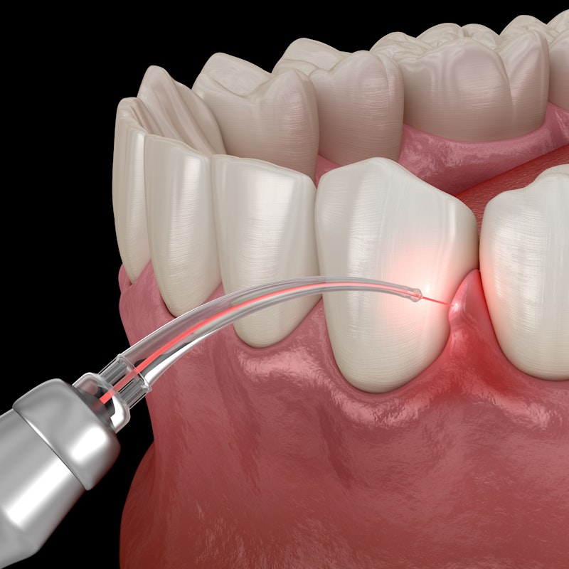 LANAP laser treatment
