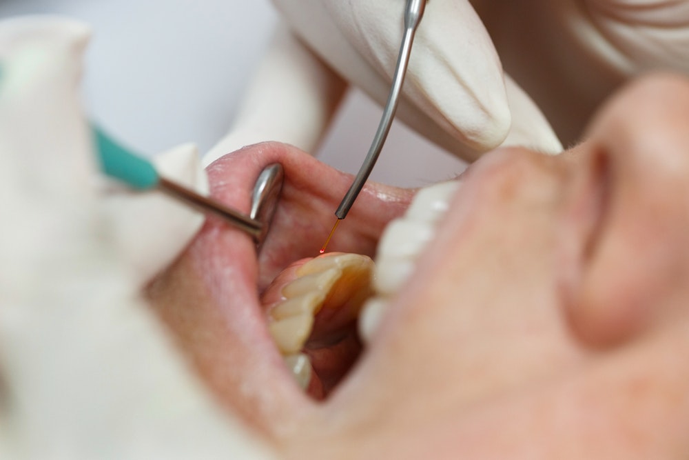 man being treated with laser dentistry