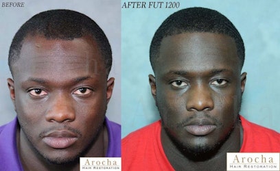 Ethnic Hair Restoration 2 African-American Hair Restoration before and after