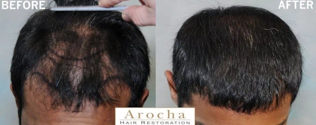 Ethnic Hair Restoration 1 Asian Hair restoration
