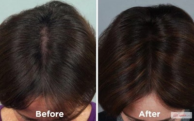 lasercap pro san antonio