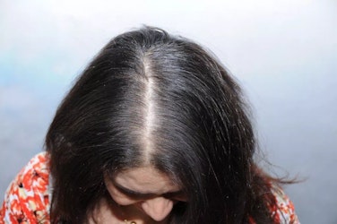 female hair loss