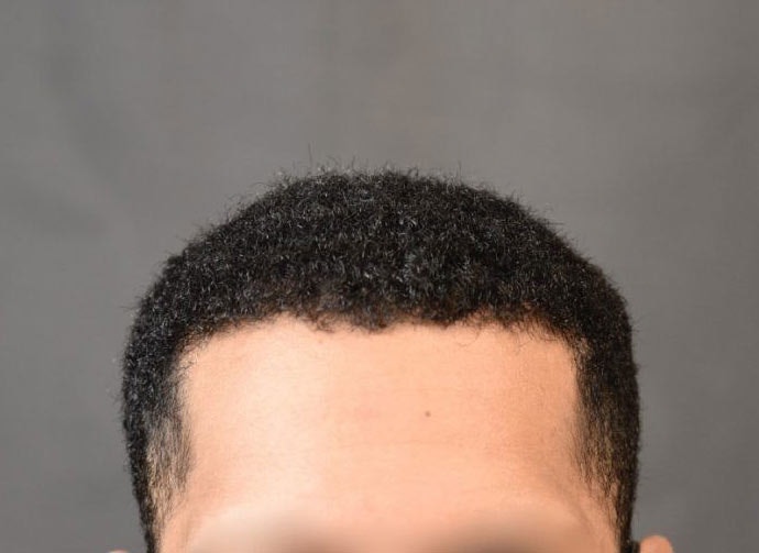 Ethnic hair restoration after