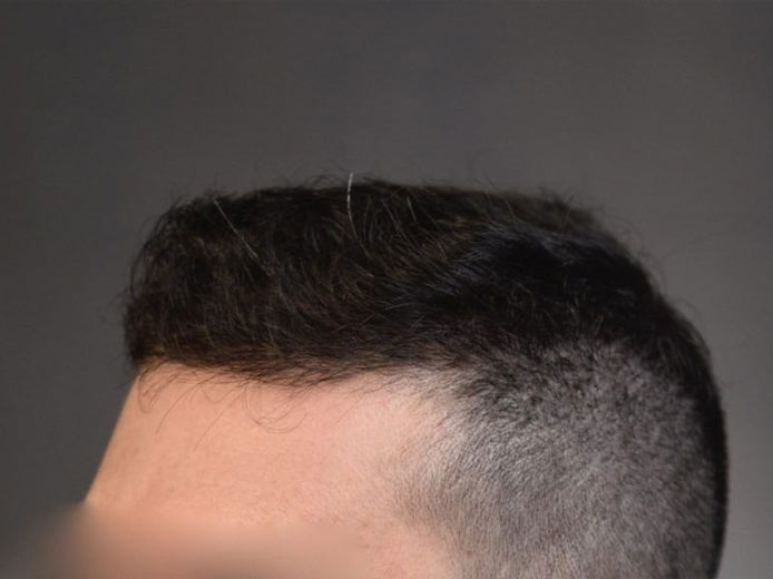 Arocha Hair Restoration: Hair Transplant in Houston, TX