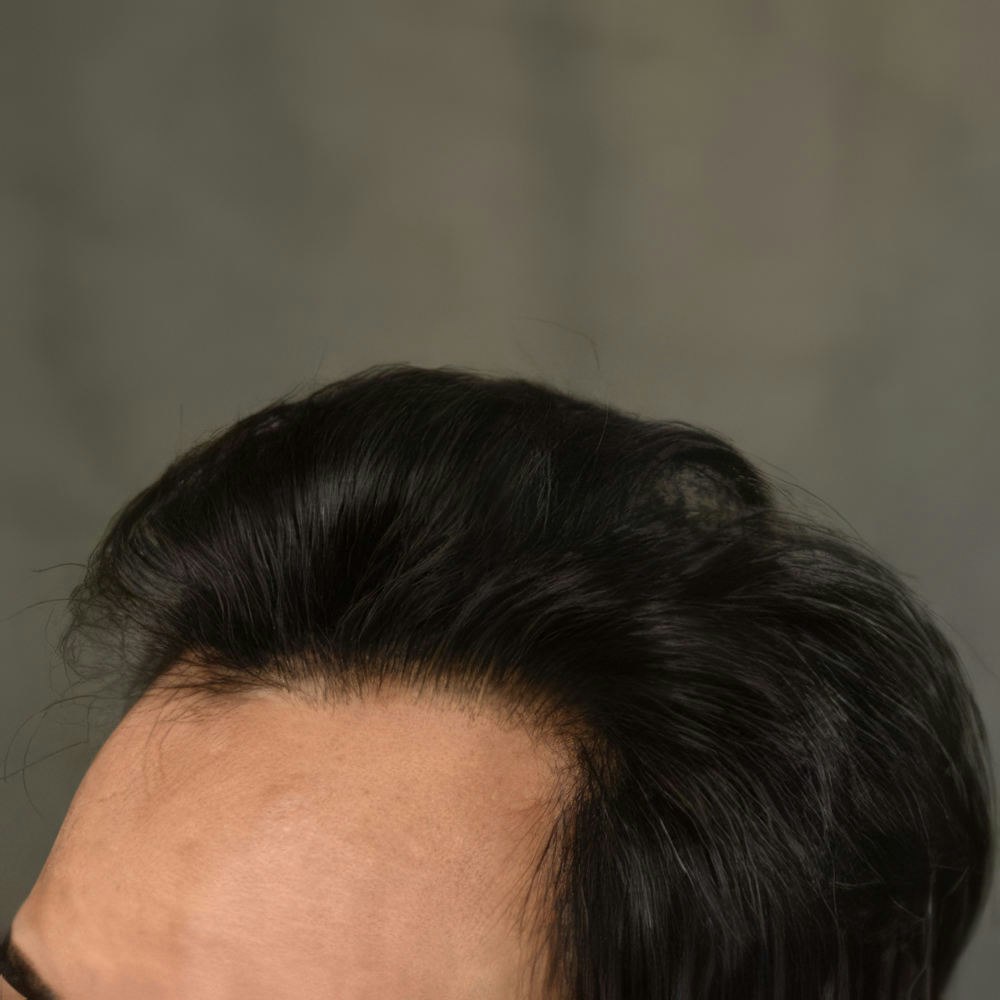 After FUE Hair Restoration: Case 18's procedure side view