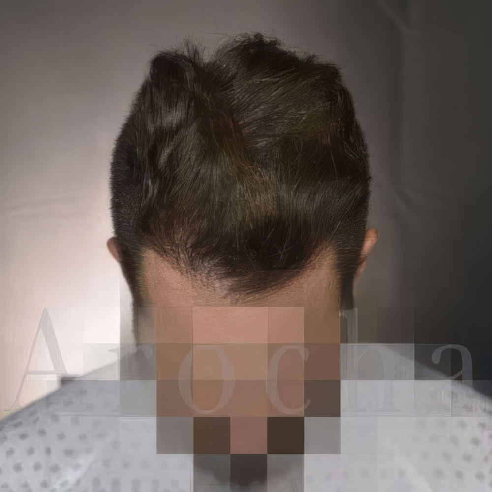 Case 1 after FUE Hair Transplant