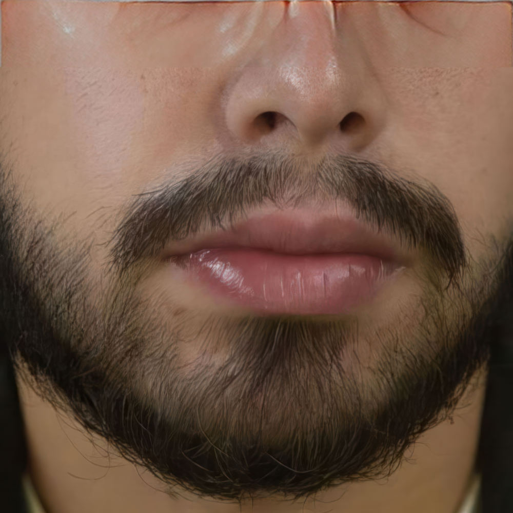 Case 2 After Facial Hair Transplant