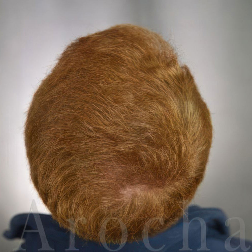 Case 1 after FUT Treatment