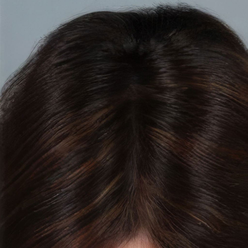 Patient after LaserCap Hair Loss Treatment