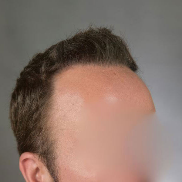 Dr. Bernardino Arocha's patient after FUT Hair restoration