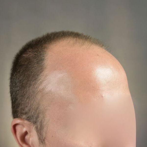Dr. Bernardino Arocha's patient before FUT Hair restoration