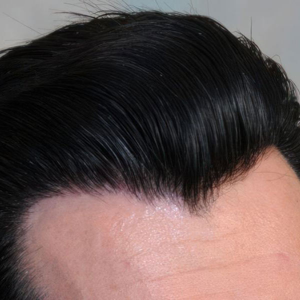 Dr. Bernardino Arocha's patient after FUT Hair Restoration