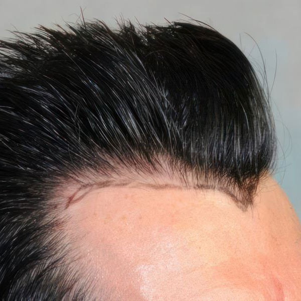 Dr. Bernardino Arocha's patient before FUT Hair Restoration