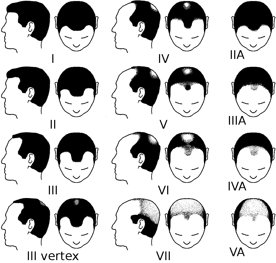 The norwood scale for male pattern baldness