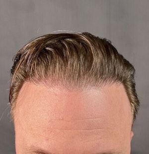 Case 1 After Corrective Hair Restoration