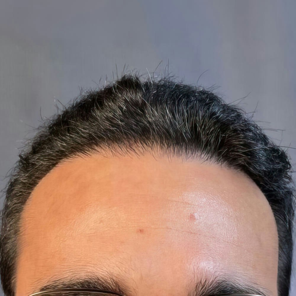 Case 2 After Hair Transplant Revision