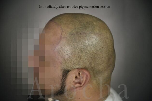Case 3 immediately after 1st trico-pigmentation session