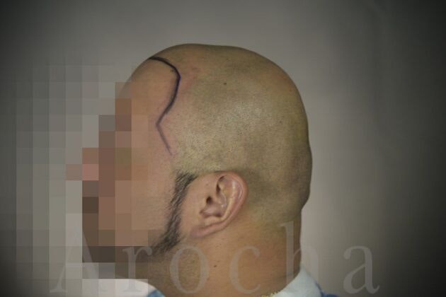 Case 3 before Scalp Micropigmentation