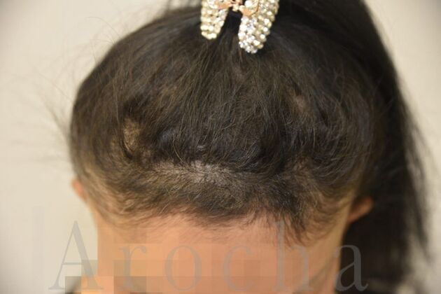 Case 2 after scalp trico-pigmentation