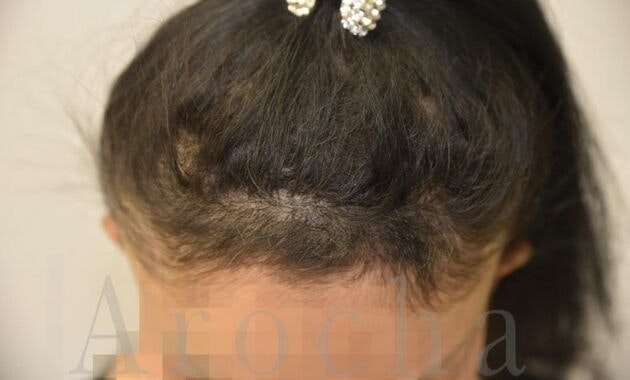 Case 2 after scalp trico-pigmentation