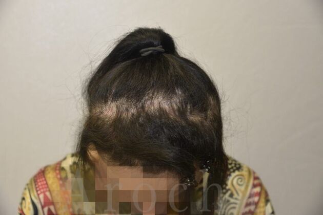 Case 2 before scalp trico-pigmentation