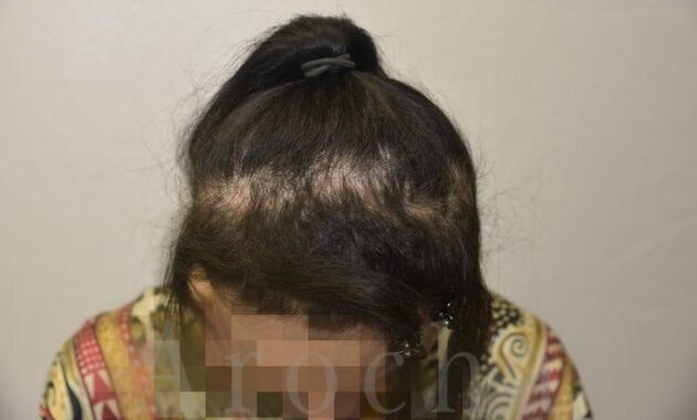 Case 2 before scalp trico-pigmentation